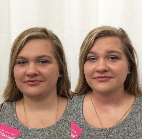 Before & After Image Of Double Chin Treatment In Charlottesville, VA By Health & Wellness Spa