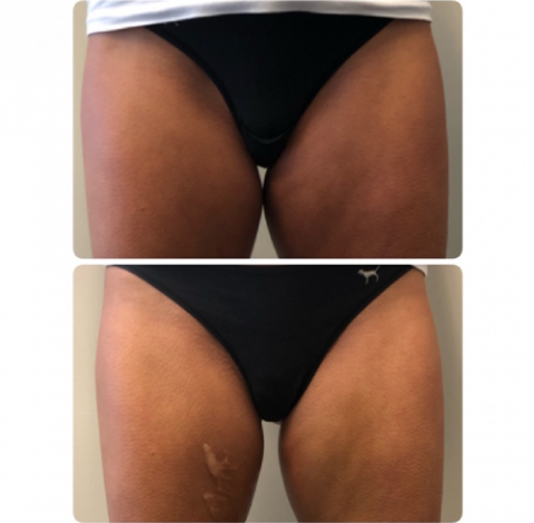 Before and After Pictures 4 Slimming Treatment By Charlottesville, VA In Health & Wellness Spa