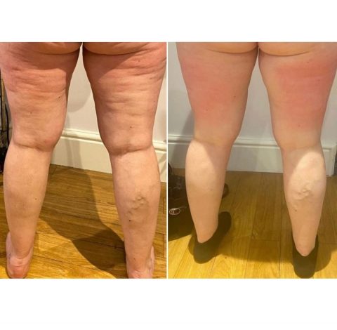 Before and After Pictures 83 Toning Treatment In Charlottesville, VA By Health & Wellness Spa