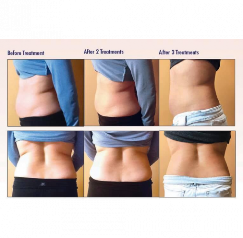Slimming Treatment By Charlottesville, VA In Health & Wellness Spa