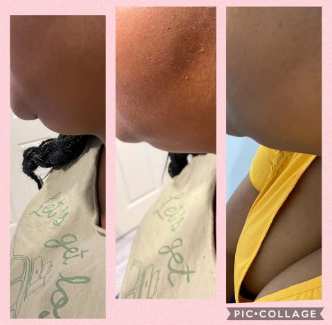 Double Chin Slimming In Charlottesville, VA By Health & Wellness Spa