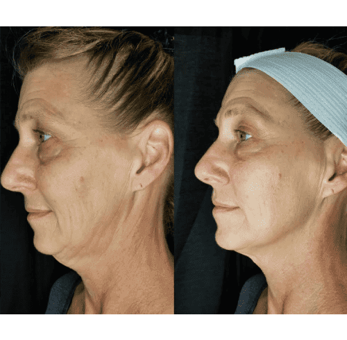 Facials Treatment Charlottesville, VA In Health & Wellness Spa