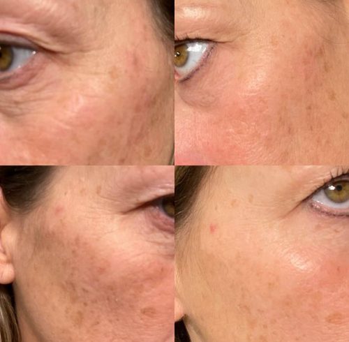 Before & After Image Of Facials In Charlottesville, VA By Health & Wellness Spa