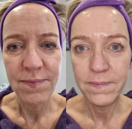 Facials Treatment In Charlottesville, VA By Health and Wellness Spa