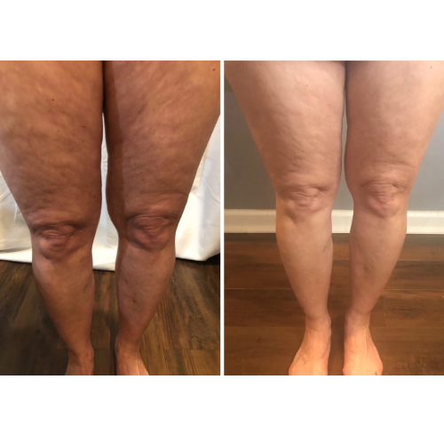 Before & After beauty treatment In Charlottesville, VA By Health & Wellness Spa