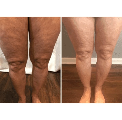 Before and after beauty treatment in Charlottesville