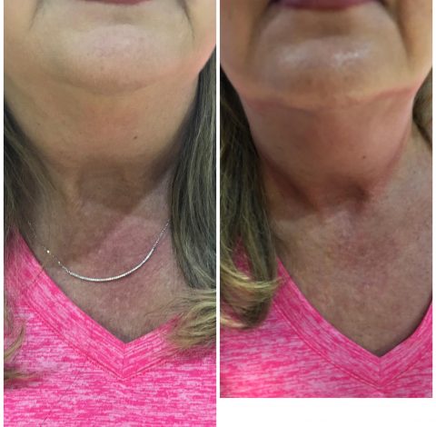 Double Chin Slimming In Charlottesville, VA By Health & Wellness Spa