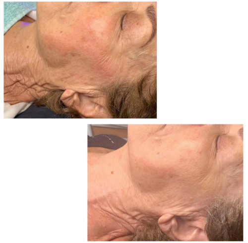 Before and After Pictures 49 Facial Treatments In Charlottesville, VA By Health & Wellness Spa