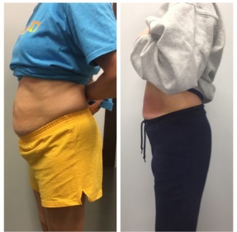 Before and After Pictures 22 Slimming Treatment In Charlottesville, VA By Health & Wellness Spa