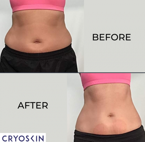 Before and After Pictures 29 Before and After Images Of Slimming Treatment By Charlottesville, VA In Health & Wellness Spa
