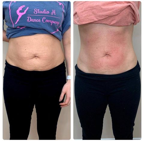 Before and After Pictures 12 Before & After Image Of Slimming Treatment In Charlottesville, VA | Health & Wellness Spa