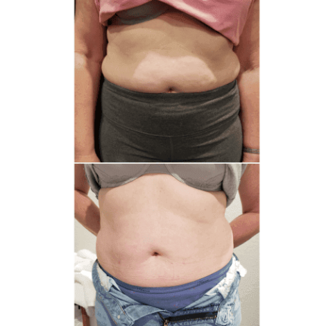 Before and after abdomen slimming treatment results Charlottesville, VA