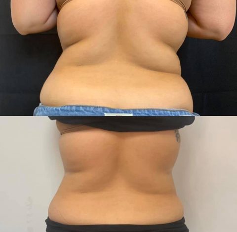 Slimming Treatment In Charlottesville, VA By Health & Wellness Spa