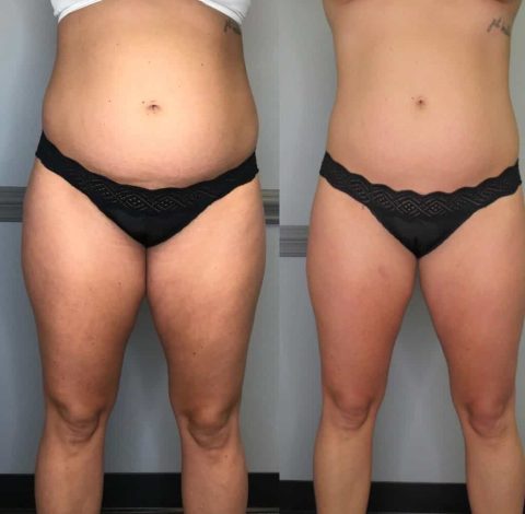 Before and after abdominal slimming treatment in Charlottesville, VA