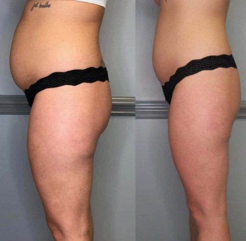 Before and after abdominal slimming treatment showing reduced belly fat