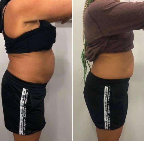 Before and after abdominal slimming in Charlottesville, VA at Health & Wellness Spa
