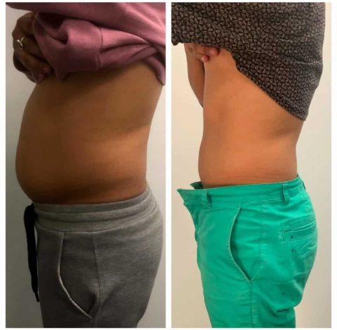 Before and after slimming treatment results on abdomen