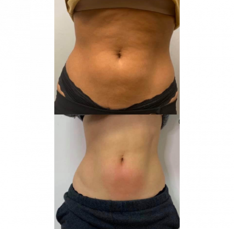 Before and After Pictures 37 Slimming Treatment By Charlottesville, VA In Health & Wellness Spa