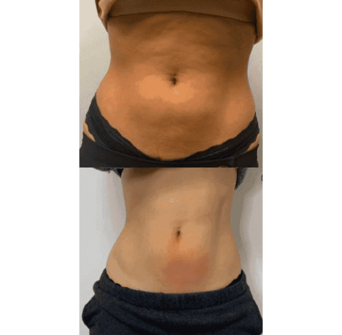 Slimming Treatment Charlottesville, VA In Health & Wellness Spa