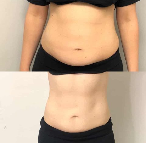 Before and after slimming treatment in Charlottesville, VA, at Health & Wellness Spa
