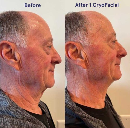 Before and after Cryo Facial in Charlottesville