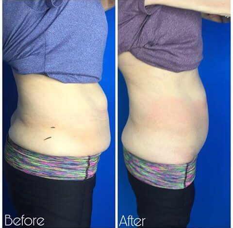 Before and after slimming treatment results on abdomen in Charlottesville, VA