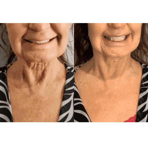CryoFacial Treatment in Charlottesville, VA by Health & Wellness Spa