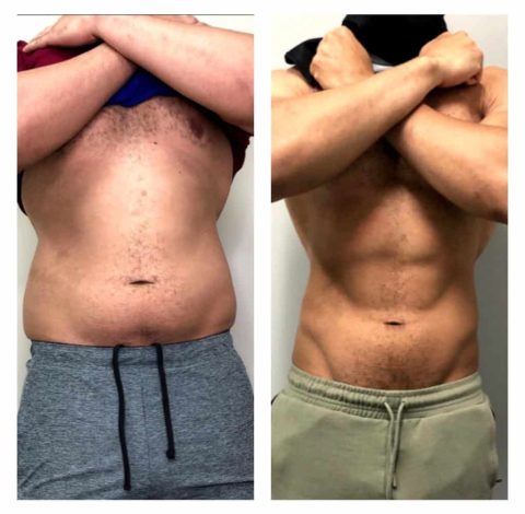 Before and after slimming treatment in Charlottesville