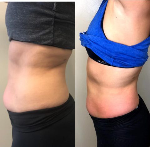 Before and after slimming treatment results on abdomen