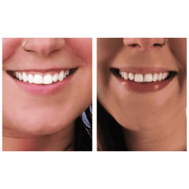 Teeth Whitening Treatment in Charlottesville, VA by Health & Wellness Spa
