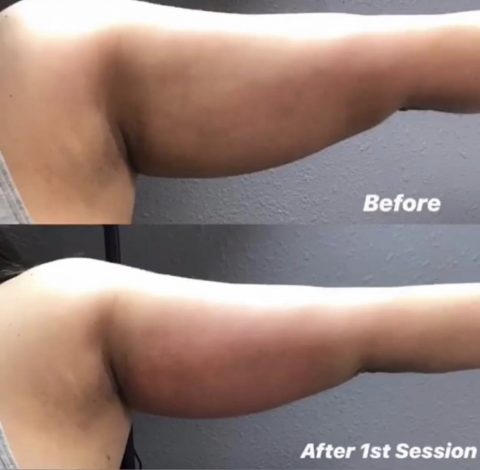 Before and After Pictures 18 Before & After Image Of Slimming Treatment In Charlottesville, VA | Health & Wellness Spa